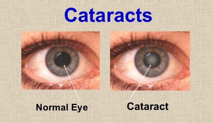 kaip atpažinti kataraktą