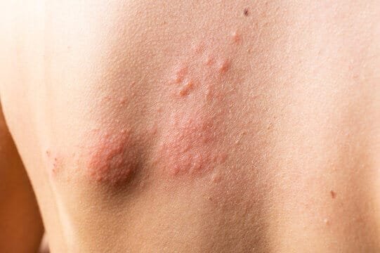 herpes virusas ant nugaros